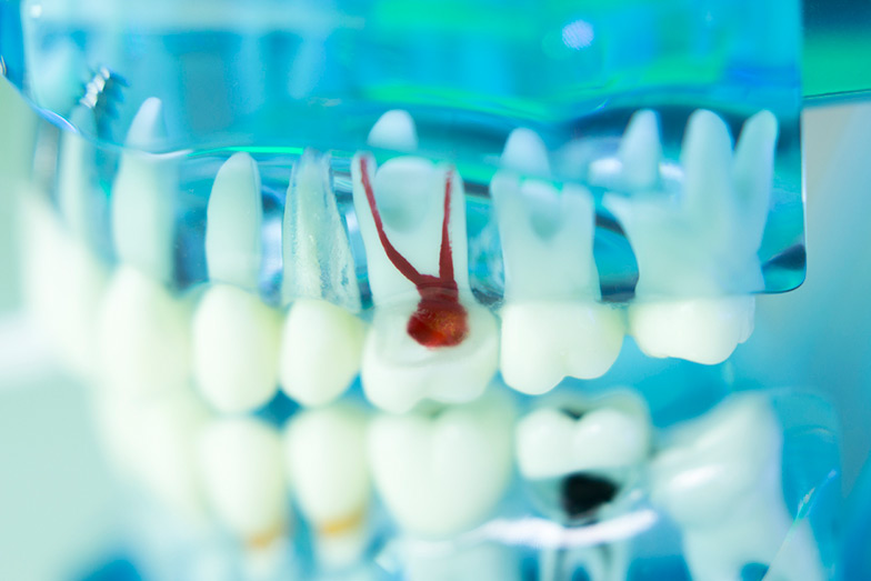 απονεύρωση, root canal treatment
