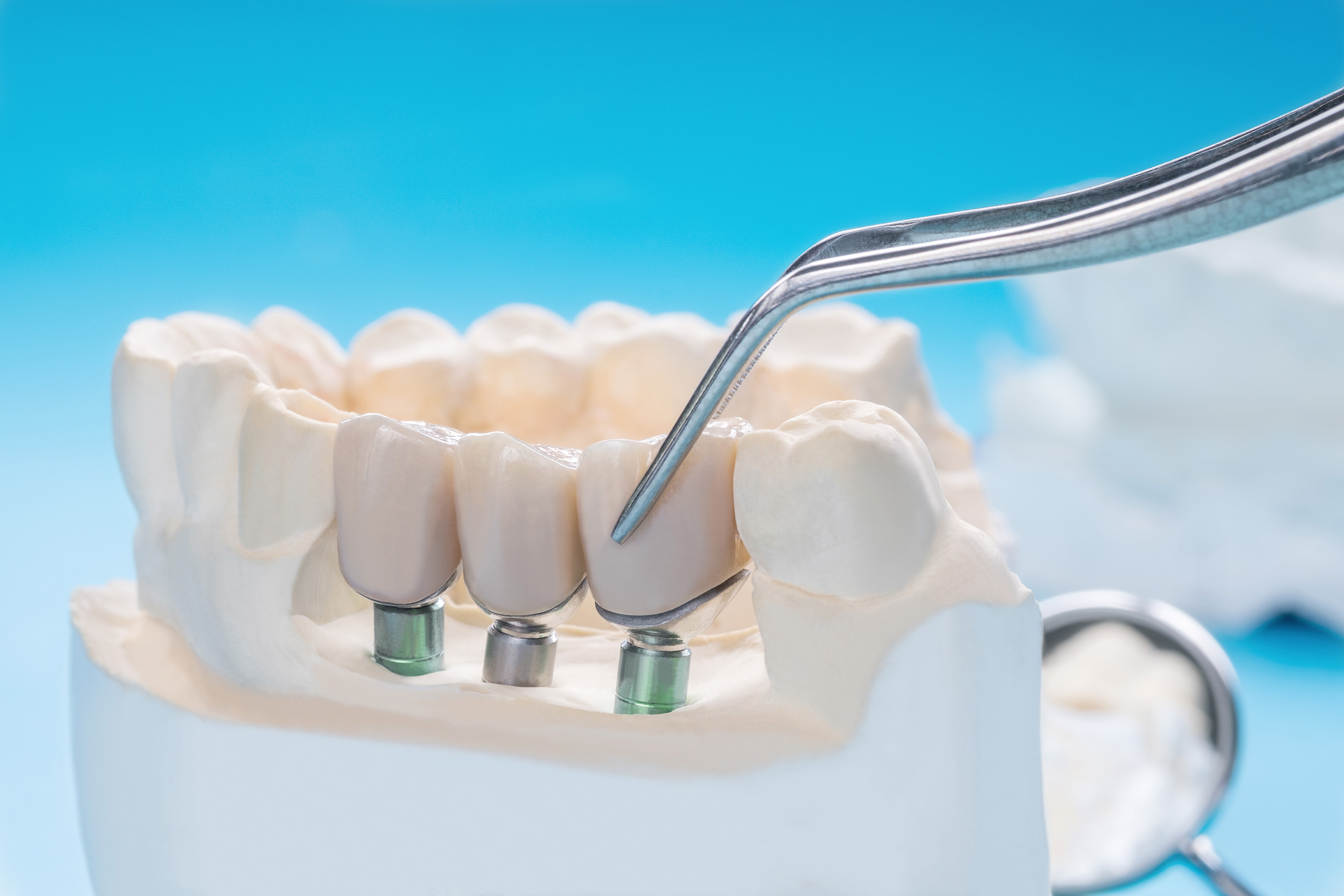 εμφυτεύματα, dental implants